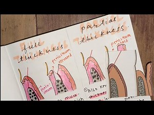 DIFFERENCE BETWEEN FULL THICKNESS AND PARTIAL THICKNESS FLAP