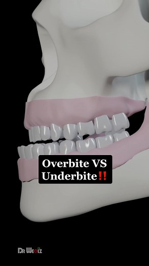 Understanding Overbite vs Underbite: Key Differences and Effects on Teeth