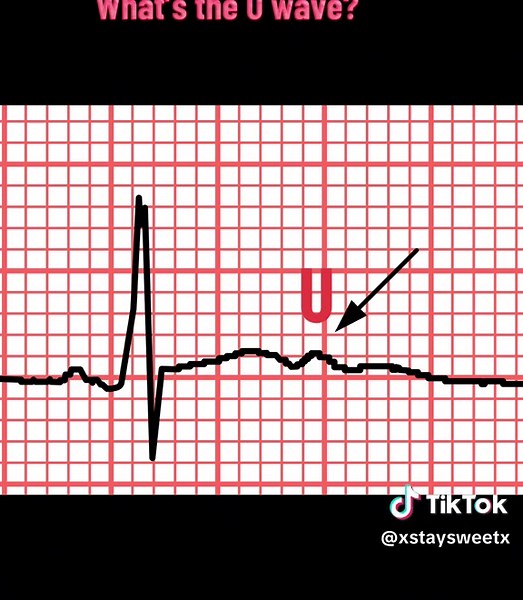 Understanding the U Wave in EKG Interpretation