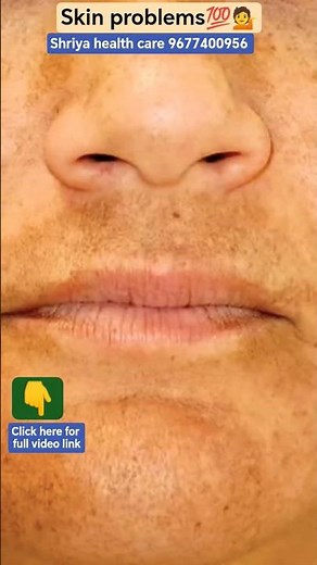 Skin problems💯💁 #shorts #viral #trending #health #skinproblems #skin #healthcare #tamil