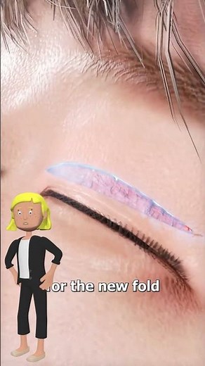 How Double Eyelid Surgery Actually Works😮