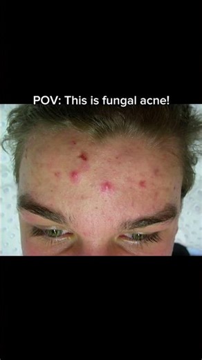 Fungal ache causes clusters of small, itchy, red bumps on your skin#fungalacne #foreheadbumps #acne