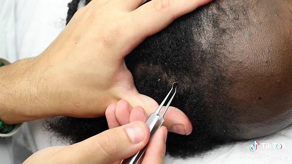 ASMR Sleep inducing Dandruff Nitpicking #asmr #relax #sleep #nails #hair #dandruff #dandrufftreatment #care #relaxing #soothing #tingles