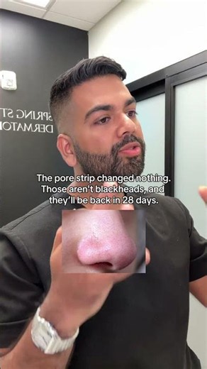 Sebaceous filaments are not blackheads.