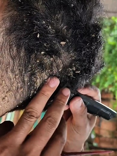 40K views · 185 reactions | Dandruff clean brings pure peace. | FlakeAway Pro | Facebook