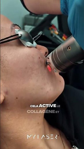 Laser Frax : Peau régénérée, cicatrices atténuées | My Laser