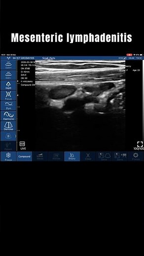 Mesenteric Lymphadenitis | DR SONO TRI-SCAN MAX Portable | Ultrasound Case