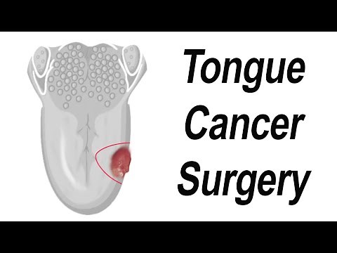 Surgical Removal of Tongue Cancer Animation