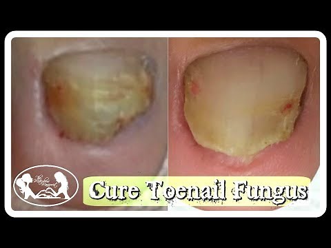Pedicure: How to Cure Toenail Fungus