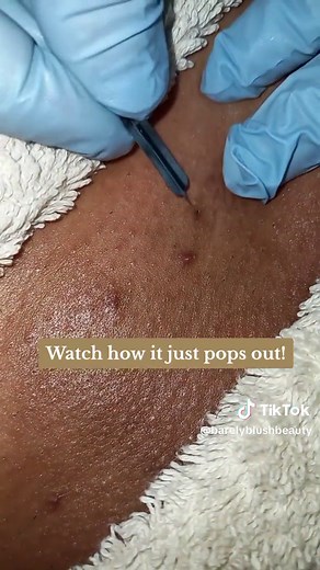 TW: ingrown hair removal, specks of blood, pubic area #fyp #fyppppppppppppppppppppppp #foryoupage #foryou #viral #trend #xyzbca #wax #waxing #ingrownremoval #ingrown #hollywood #ingrowns