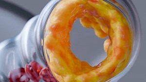 Cholesterrol or Atherosclerotic Plaque in blood vessels, Blocked vessel stroke, Thickened Arteries and Veins, Coronary, fat buildup clogging, Atherosclerosis or atheromatous Hyperlipidemia, 3d render