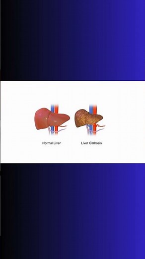 PORTAL HYPERTENSION! HEPATIC PORTAL VEIN! #liver #hepatic #cirrhosis #thrombosis #bloodflow