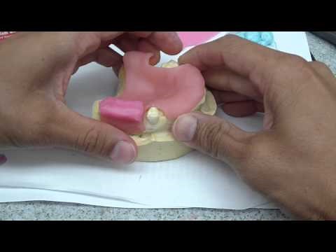 Immediate Denture/RPD Jaw Relationship Record Fabrication