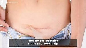 All You Need To Know About Caring For Your C-Section Scar Video - MomJunction