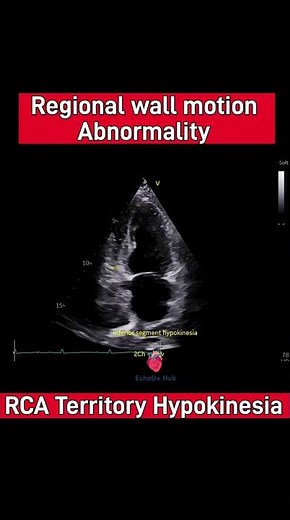Hypokinesia in RCA Territory – Ischemic Wall Motion Abnormality #echocardiography #2decho