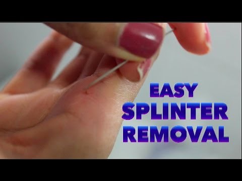 How to remove a splinter from your hand - Pain free way!