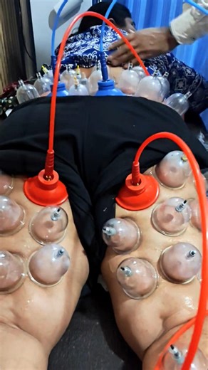 Sciatica Pain Cure | Cupping Therapy for L4 L5 S1 Nerve Pain (No Surgery)#painrelief #physiotherapy