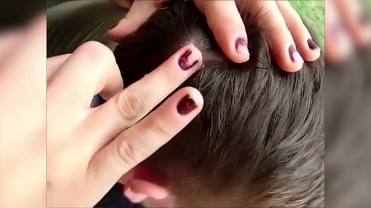 Huge botfly removed from travellers head after a month inside