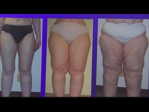Lipedema: Women gaining weight at no fault of their own