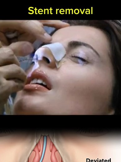 Septoplasty stent removal after septum surgery #septoplasty #splinterremoval #splint #deviatedseptum #septum #sinusrelief