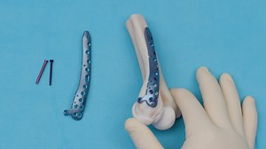 Distal Humerus Fracture Fixation With the Arthrex Distal Humerus Posterolateral Plate