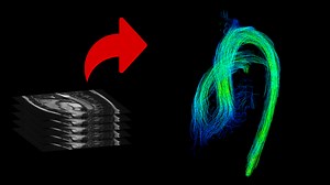iTSimulation | Cardio Flow Design
