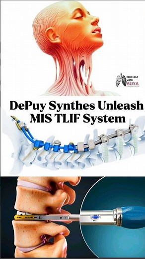 DePuy Synthes Unleash MIS TLIF System #medical #animation #3d #short