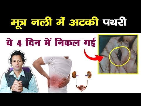 Peshab ki nali me pathri | पथरी के लक्षण | bladder stone | मूत्राशय की पथरी | पथरी | Dr tarun