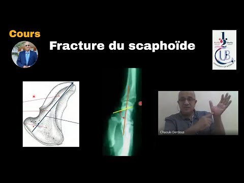 Les fractures du scaphoïde