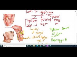 carcinoma of hypopharynx || ENT