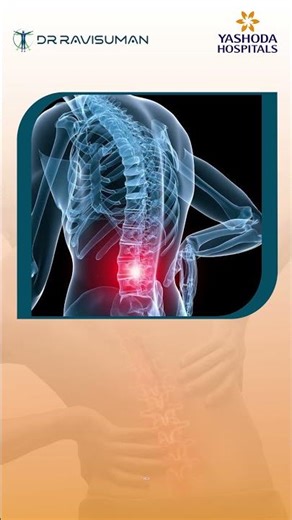 Lingering Lower Back Pain? S4-L5 Nerve Compression Explained by Top Spine Surgeon | Dr. Ravi Suman