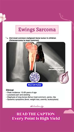 𝐃𝐫.𝐌𝐚𝐧𝐚𝐥𝐢 | 𝐇𝐄𝐀𝐋𝐓𝐇 & 𝐌𝐄𝐃𝐈𝐂𝐈𝐍𝐄 on Instagram: "🦴 Ewing’s Sarcoma 💡 🔑 High-Yield Points: ♦️Age: 10–20 years (adolescents) 👦👧 ♦️Location: Diaphysis of long bones (femur, tibia, humerus) & pelvis ♦️Pathophysiology: Translocation t(11;22)(q24;q12) → EWS-FLI1 fusion gene ♦️Clinical features: Pain, swelling, sometimes fever; may mimic osteomyelitis ❗Radiology: “Onion-skin” periosteal reaction, lytic lesions on X-ray ❗Histology: Small round blue cells ❗Management: Multi-modal –