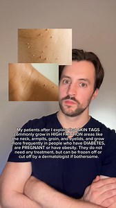 Skin tags | Dermarkologist