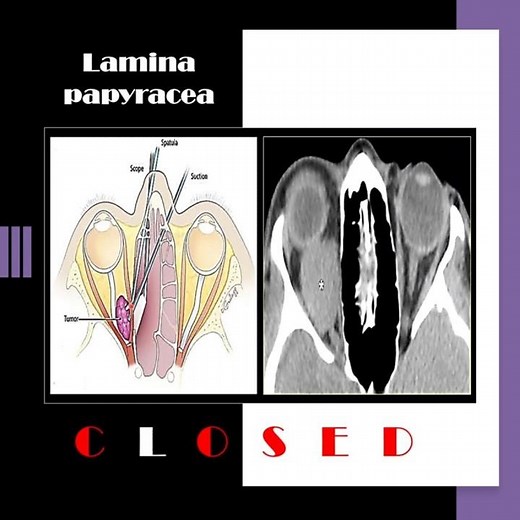 Nose radiology series (19); The lamina papyracea (15) #shorts