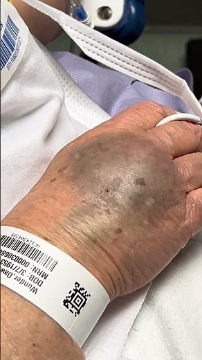 Open heart triple bypass ready