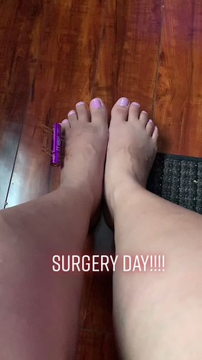 Toelengthening Surgery for Brachymetatarsia Removal