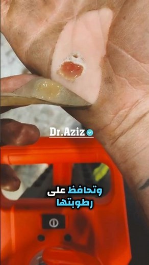 لصقات الجروح وأهميتها للتشافي