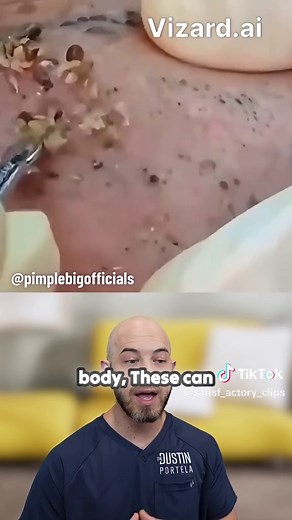 Nevis Comedonicus: Understanding Blackhead Clusters