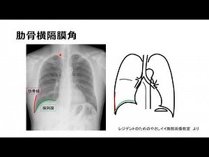 胸部X線写真読影キーワード解説動画9 肋骨横隔膜角