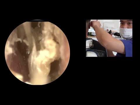 BÁC CHỈ ĐƯỢC LẤY RÁY TAI THÔI CHƯ KHÔNG ĐƯỢC TIÊM CHÁU | 耳かき - ASMR 耳掃除 BS LẠI MINH TUẤN