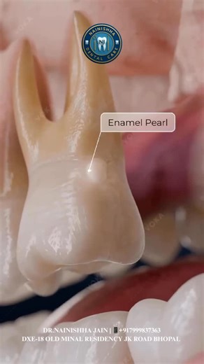 Nainishha Dental Care✨🦷 on Instagram: "🦷 Enamel Pearl • An enameloma (also called enamel pearl) is a dental anomaly where enamel forms outside the normal tooth crown. • It appears as a small, round nodule of enamel on the tooth root surface. • Caused by ameloblasts (cells that form enamel) depositing enamel ectopically in the wrong place. 📌 Why It’s a Problem • Disrupts the normal attachment of the periodontal ligament to the tooth root’s cementum. • Creates a weak spot in the biological seal