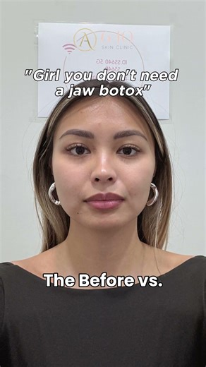 “Girl, you don’t need a jaw botoxx… ”Meanwhile her face after: 👁️👄👁️✨ #FaceSlimming