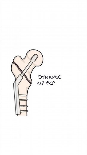 Hip Fracture Types and Management Explained #medicalstudent #anatomy #orthopaedics #biology