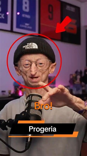 Progeria Explained | A Rare Condition That Causes Rapid Aging 🧬