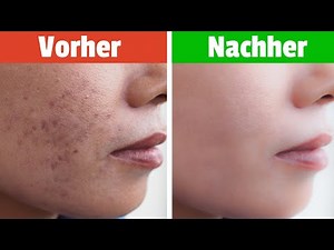 Die Ursachen von Akne – Wie man sie schnell los wird