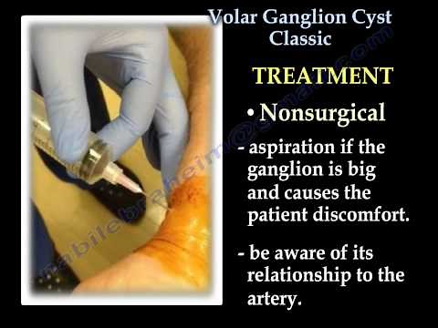 Ganglion Cyst of the wrist, volar - Everything You Need To Know - Dr. Nabil Ebraheim