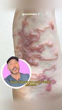 UNA LARVA QUE PUEDE CRECER DEBAJO DE TU PIEL | LARVA MIGRANS CUTÁNEA