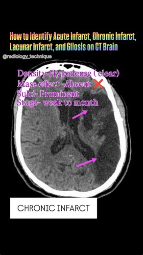 How to Identify Acute Infarct, Chronic Infarct, Lacunar Infarct, and Gliosis on CT Brain.. #radiology #radiography #radiographer #radiologist #mbbsstudent #mbbs #mbbslife #medicos #medicogirl #medico #infarct #gliosis #neutology #neurologia #neurologia #neurologia #radiologia #radiographer #radiology_technique #reels #explore #viralreels #science #xraytech #xrays #ctscan #ctscan #fby #fbchallenge #fb #fbreels #viralreels | Diwakar Patel