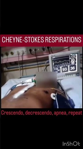 Cheyne-Stokes breathing