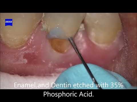 Class V composite restoration video